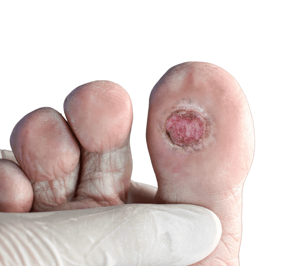 diabetic foot ulcers