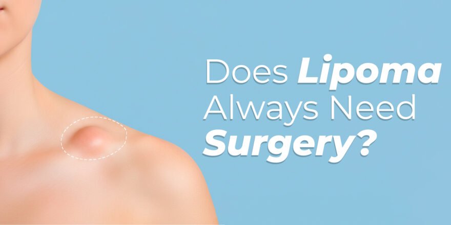 Does Lipoma Always Need Surgery