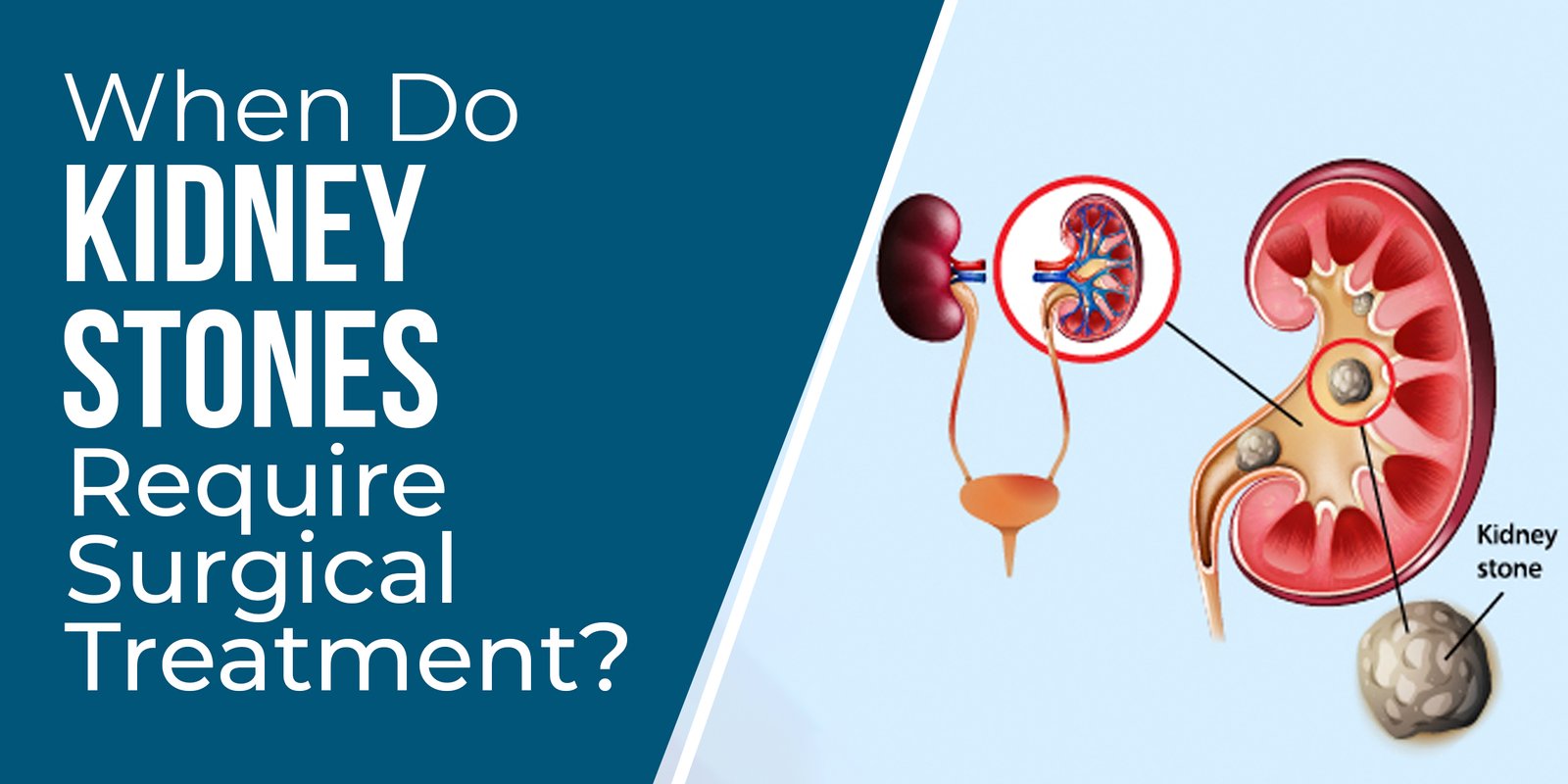 When Do Kidney Stones Require Surgical Treatment?
