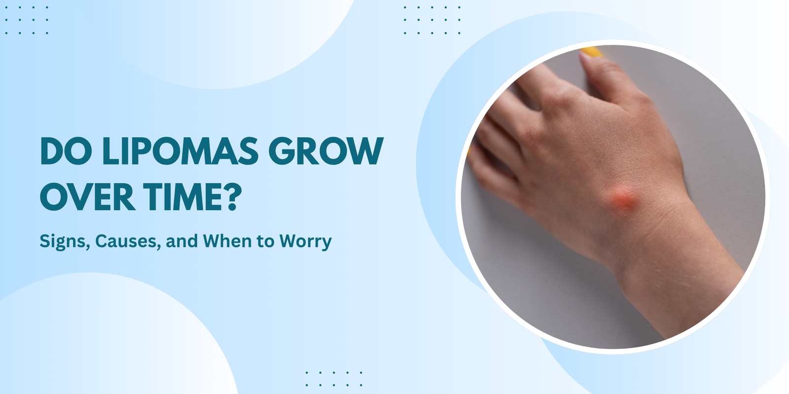 Do Lipomas Grow Over Time? Signs, Causes, and When to Worry