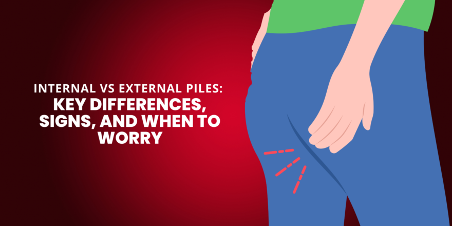 Internal vs External Piles: Key Differences, Signs, and When to Worry